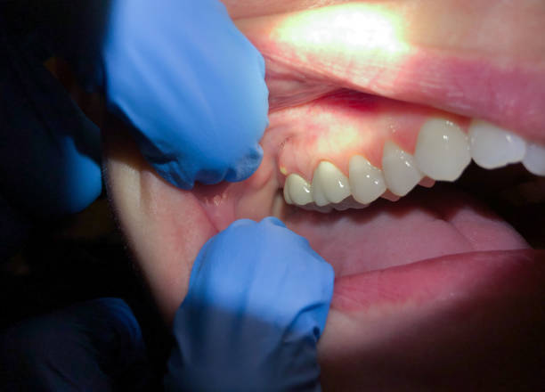 Best Emergency Dentist for Lost Fillings or Crowns in San Pablo, NM